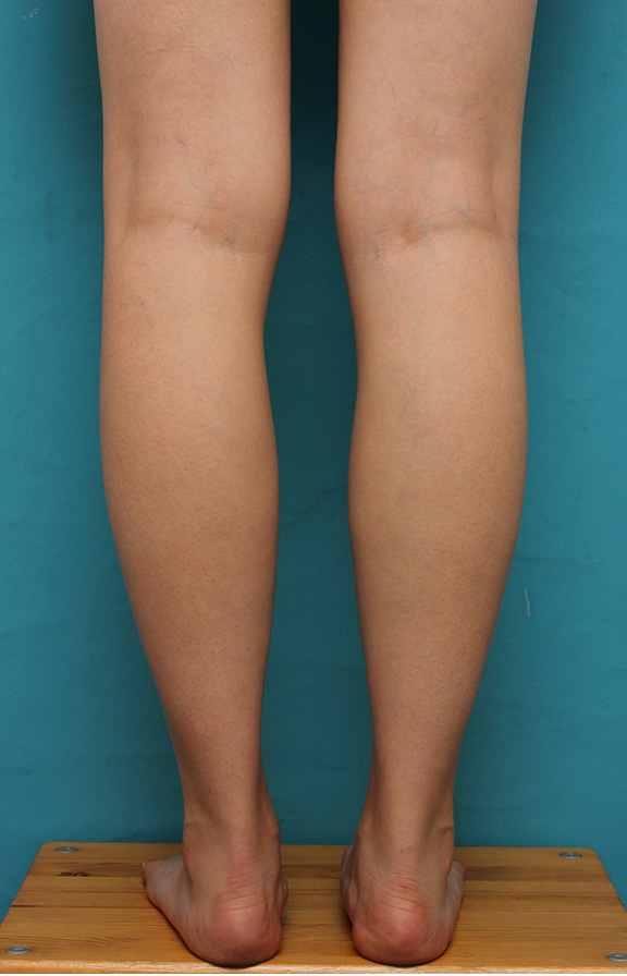 症例写真,ふくらはぎボツリヌストキシン注射で、細い脚を更に細くした症例写真,Before,ba_leg011_b01.jpg