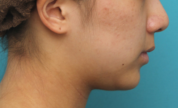 症例写真,上口唇リフト（人中短縮、リップリフト）で長い鼻の下を短くした症例写真,Before,ba_hanashita001_b06.jpg