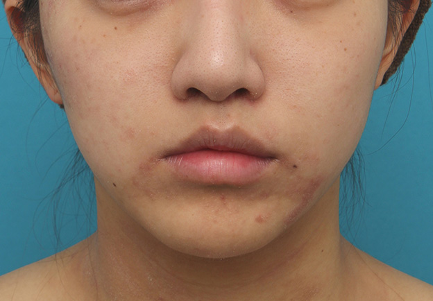 症例写真,上口唇リフト（人中短縮、リップリフト）で長い鼻の下を短くした症例写真,3週間後,mainpic_hanashita001d.jpg