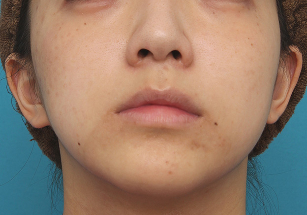 症例写真,上口唇リフト（人中短縮、リップリフト）で長い鼻の下を短くした症例写真,手術前の下から見た状態（あおり）,mainpic_hanashita001f.jpg