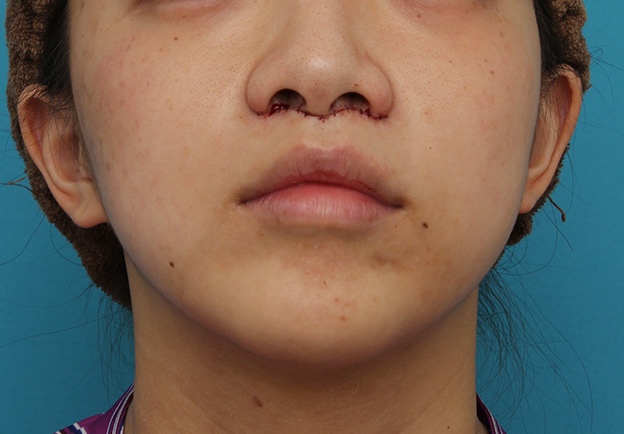 症例写真,上口唇リフト（人中短縮、リップリフト）で長い鼻の下を短くした症例写真,手術直後の下から見た状態,mainpic_hanashita001g.jpg