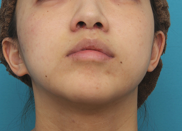 症例写真,上口唇リフト（人中短縮、リップリフト）で長い鼻の下を短くした症例写真,6日後の下から見た状態,mainpic_hanashita001h.jpg