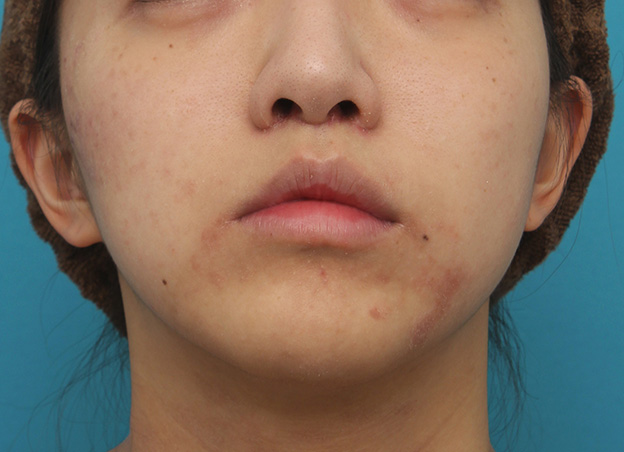 症例写真,上口唇リフト（人中短縮、リップリフト）で長い鼻の下を短くした症例写真,3週間後,mainpic_hanashita001i.jpg