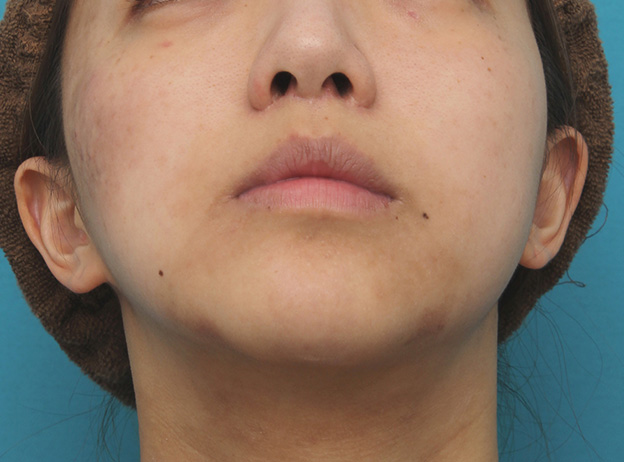 症例写真,上口唇リフト（人中短縮、リップリフト）で長い鼻の下を短くした症例写真,6ヶ月後の下から見た状態,mainpic_hanashita001j.jpg