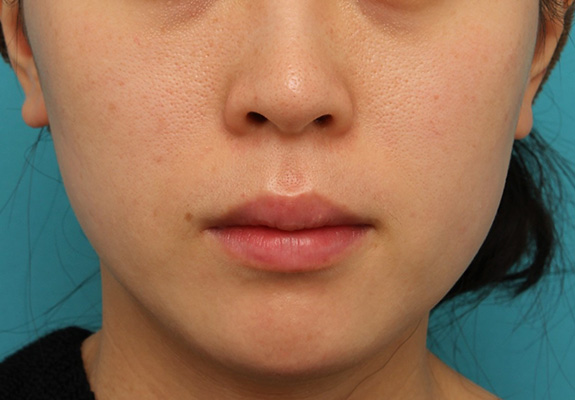 症例写真,上下の唇にヒアルロン酸を注射し、薄い唇を厚くセクシーにした症例写真,After（1ヶ月後）,ba_atsuku016_b01.jpg