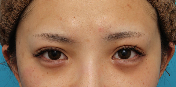 症例写真,ヒアルロン酸注射でやや大きめの涙袋を作った症例写真,After（ヒアルロン酸注射後1ヶ月）,ba_namida013_b01.jpg