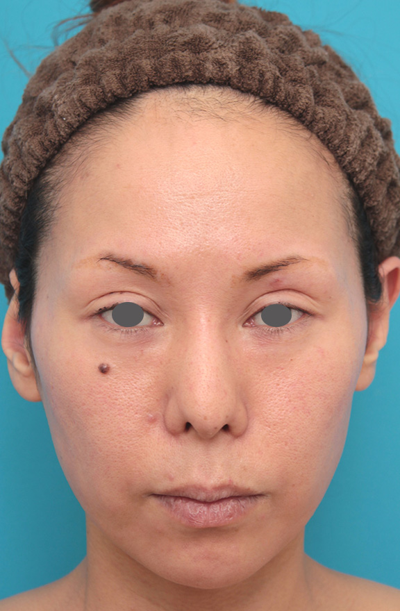症例写真,顔全体にイタリアンリフトファイン（吸収糸による肌の張りの治療）を行った症例写真,After（1年後）,ba_italianlift_fine019_b01.jpg