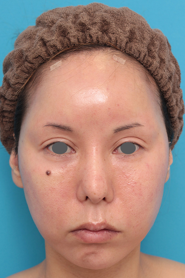 症例写真,顔全体にイタリアンリフトファイン（吸収糸による肌の張りの治療）を行った症例写真,手術直後,mainpic_italianlift_fine019b.jpg