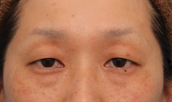 症例写真,眼瞼下垂手術でまぶたの開きを良くし、自然な二重まぶたを作った症例写真,Before,ba_ganken038_b01.jpg
