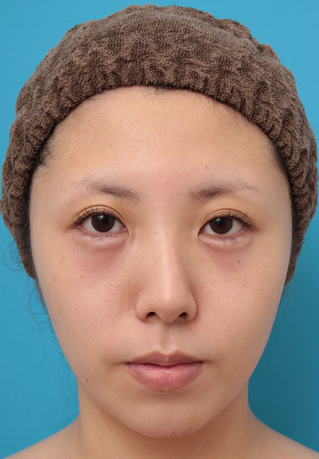 症例写真,患者様の希望で超幅広平行型二重を全切開法で行い、同時に目頭切開、目尻切開、タレ目形成を行った症例写真,手術前,目を開けた状態,mainpic_sekkai061a.jpg