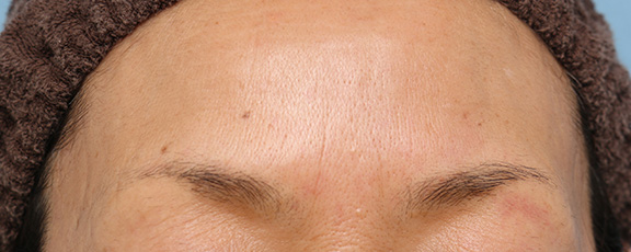 症例写真,｢眉間のしわ｣をボツリヌストキシン注射で改善させる症例写真,After（1ヶ月後）,ba_botox008_b01.jpg