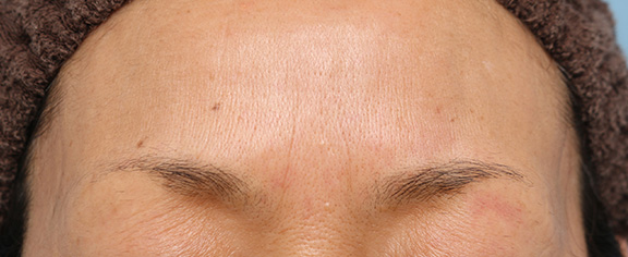 症例写真,｢眉間のしわ｣をボツリヌストキシン注射で改善させる症例写真,After（1ヶ月後の眉間にしわ寄せの状態）,ba_botox008_b02.jpg
