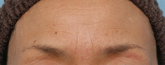 症例写真,｢眉間のしわ｣をボツリヌストキシン注射で改善させる症例写真,Before,ba_botox008_b01.jpg