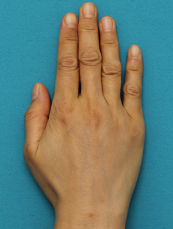 手の甲をふっくらさせるヒアルロン酸注射の症例写真,After（1ヶ月後）,ba_hyaluronic033_a01.jpg