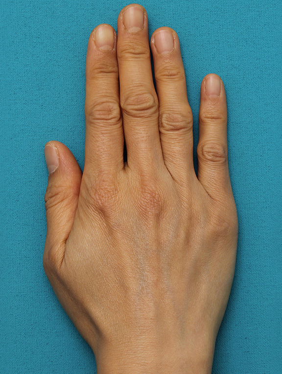 症例写真,手の甲をふっくらさせるヒアルロン酸注射の症例写真,Before,ba_hyaluronic033_b01.jpg