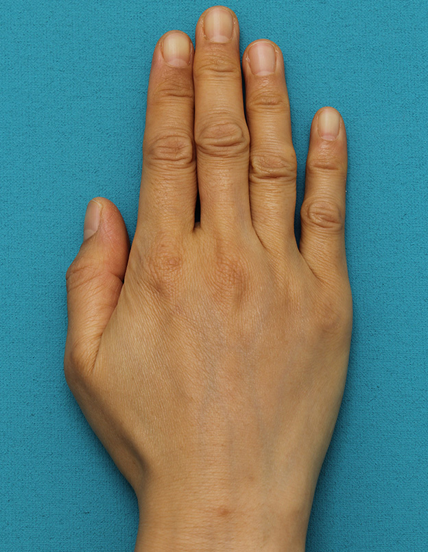 注射式シワ取り 長期持続型ヒアルロン酸注入,手の甲をふっくらさせるヒアルロン酸注射の症例写真,1ヶ月後,mainpic_hyaluronic033c.jpg