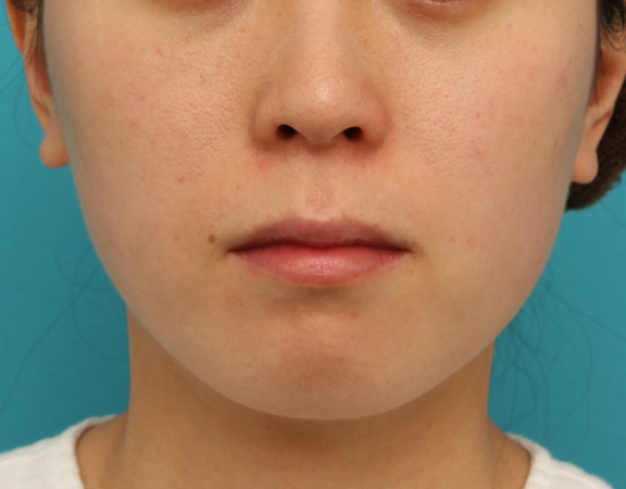 長期持続型ヒアルロン酸注射で顎先を下に伸ばさないように前に出して尖らせた症例写真,Before,ba_agochu013_b01.jpg