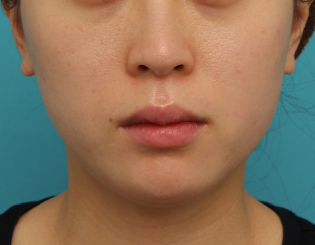 症例写真,長期持続型ヒアルロン酸注射で顎先を下に伸ばさないように前に出して尖らせた症例写真,1週間後,mainpic_agochu013c.jpg