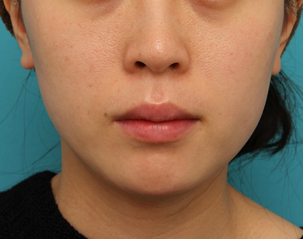 症例写真,長期持続型ヒアルロン酸注射で顎先を下に伸ばさないように前に出して尖らせた症例写真,1ヶ月後,mainpic_agochu013d.jpg