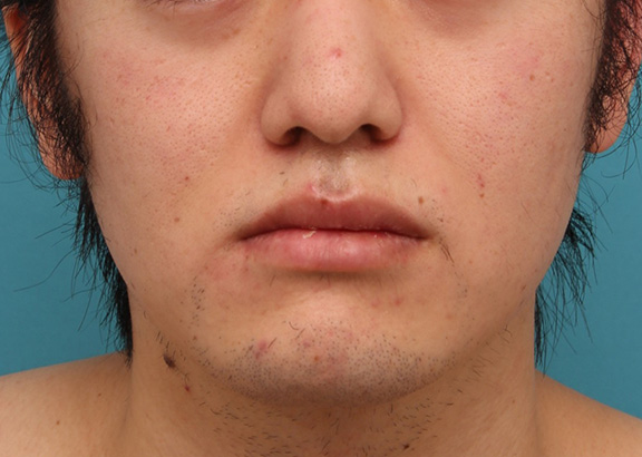 症例写真,明らかに厚い唇を手術で薄くして平均サイズくらいにした20代男性の症例写真,After（6ヶ月後）,ba_usuku010_b01.jpg