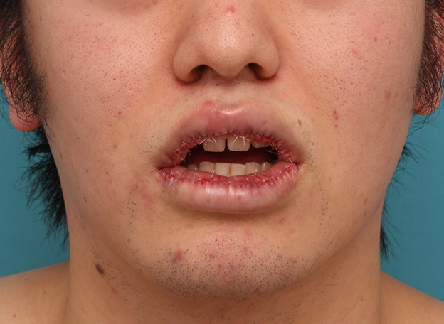 症例写真,明らかに厚い唇を手術で薄くして平均サイズくらいにした20代男性の症例写真,手術直後,口を開けた状態,mainpic_usuku010d.jpg