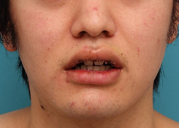 症例写真,明らかに厚い唇を手術で薄くして平均サイズくらいにした20代男性の症例写真,5日後,口を開けた状態,mainpic_usuku010f.jpg