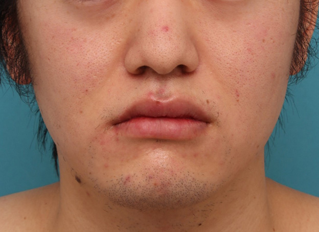症例写真,明らかに厚い唇を手術で薄くして平均サイズくらいにした20代男性の症例写真,8日後,口を閉じた状態,mainpic_usuku010g.jpg