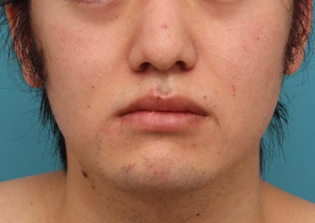 症例写真,明らかに厚い唇を手術で薄くして平均サイズくらいにした20代男性の症例写真,6ヶ月後,口を閉じた状態,mainpic_usuku010i.jpg