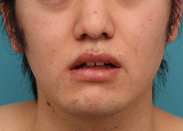 症例写真,明らかに厚い唇を手術で薄くして平均サイズくらいにした20代男性の症例写真,6ヶ月後,口を半開きにした状態,mainpic_usuku010j.jpg