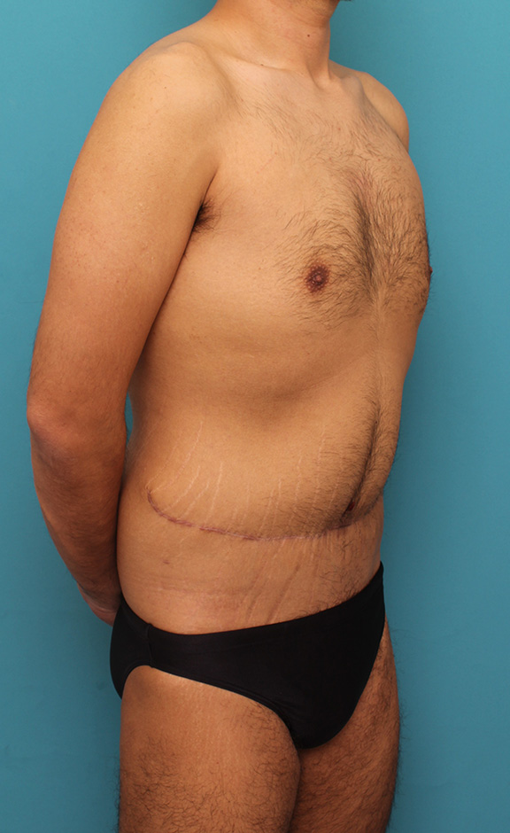 症例写真,お腹の皮膚のたるみとり手術(腹部リダクション)を行った30代男性の症例写真,After(6ヶ月後),ba_hara002_b02.jpg