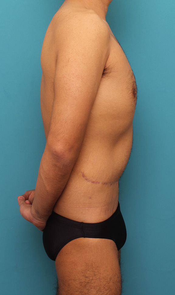 症例写真,お腹の皮膚のたるみとり手術（腹部リダクション）を行った30代男性の症例写真,After（6ヶ月後）,ba_hara002_b03.jpg