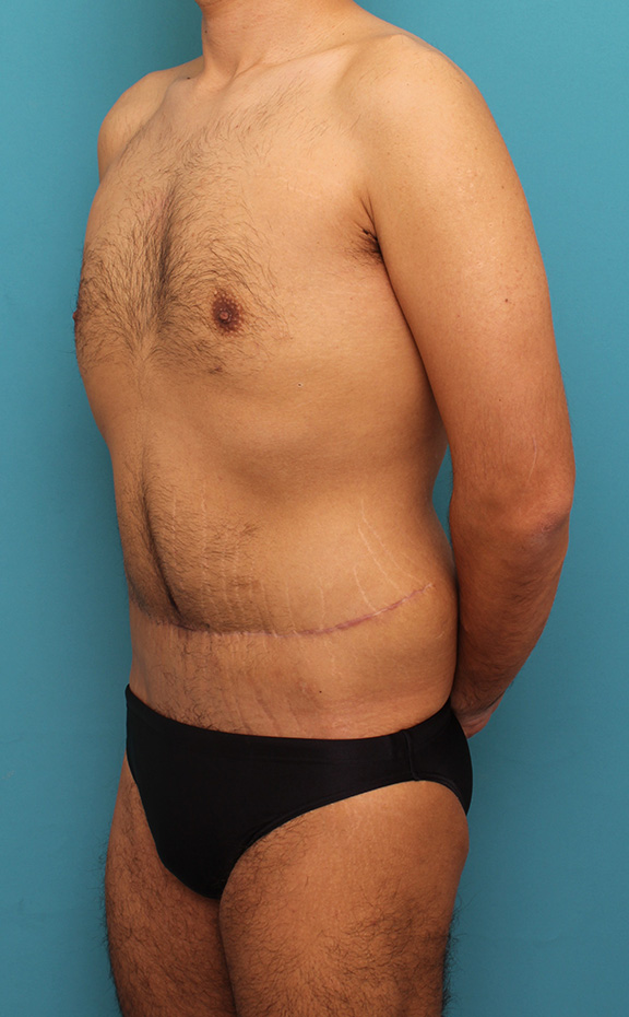 症例写真,お腹の皮膚のたるみとり手術(腹部リダクション)を行った30代男性の症例写真,After(6ヶ月後),ba_hara002_b04.jpg