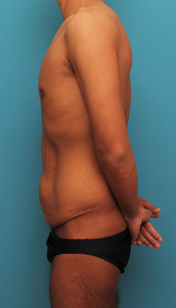 症例写真,お腹の皮膚のたるみとり手術(腹部リダクション)を行った30代男性の症例写真,Before,ba_hara002_b05.jpg