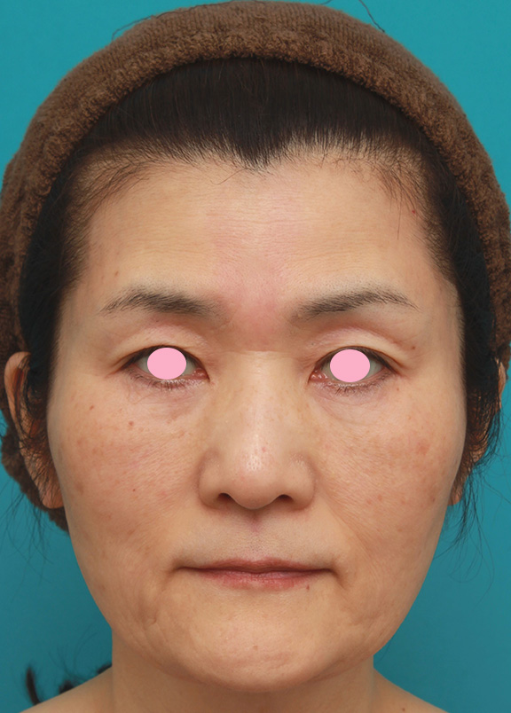 症例写真,50代後半女性のたるんだ顔に脂肪溶解注射を行って小顔にした症例写真,Before,ba_meso_face009_b01.jpg
