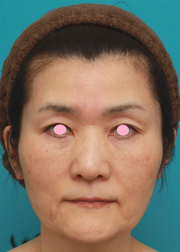 症例写真,50代後半女性のたるんだ顔に脂肪溶解注射を行って小顔にした症例写真,治療前,mainpic_meso_face009a.jpg