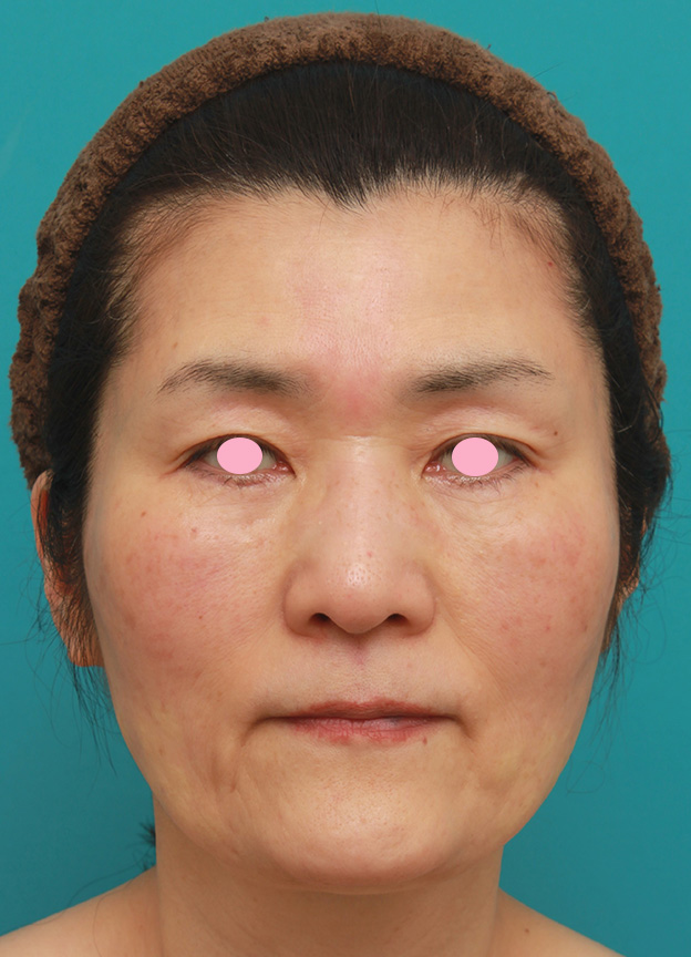 症例写真,50代後半女性のたるんだ顔に脂肪溶解注射を行って小顔にした症例写真,1回目注射後,mainpic_meso_face009b.jpg