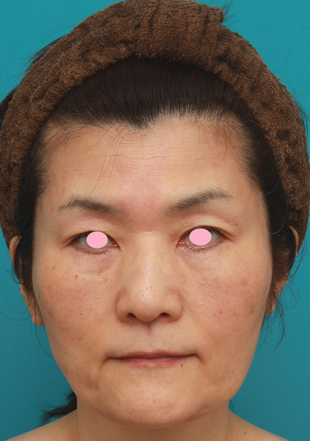 50代後半女性のたるんだ顔に脂肪溶解注射を行って小顔にした症例写真 美容整形の高須クリニック 東京赤坂 横浜 名古屋 大阪 50代後半女性のたるんだ顔に脂肪溶解注射を行って小顔にした症例写真 美容整形の高須クリニック 東京赤坂 横浜 名古屋 大阪