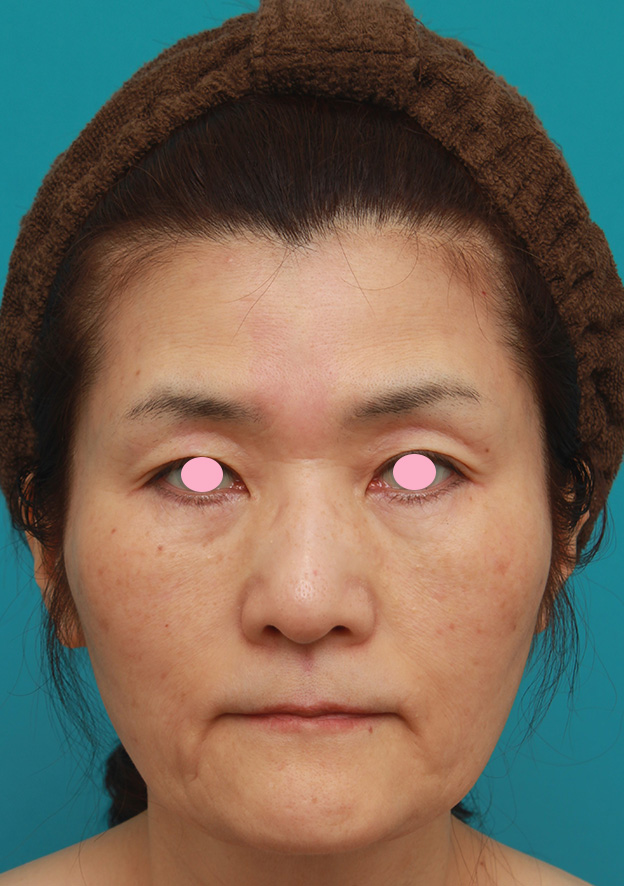 症例写真,50代後半女性のたるんだ顔に脂肪溶解注射を行って小顔にした症例写真,3回目注射後,mainpic_meso_face009d.jpg