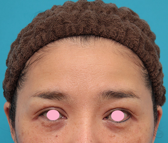 髪の毛の生え際で切開する額リフトでおでこのシワを伸ばした症例写真,Before,ba_hitailift003_b01.jpg