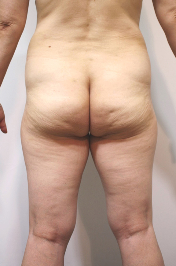 腰、ウェスト、お尻の脂肪吸引をして、後ろ姿が改善した50代女性の症例写真,Before,ba_shibokyuin038_b01.jpg