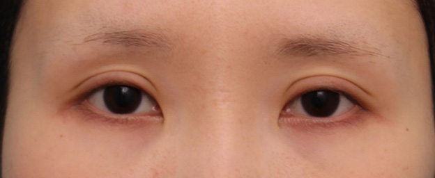 症例写真,20代女性に全切開二重術を行い、幅広の平行二重にした症例写真,6ヶ月後,メイクなし,mainpic_sekkai063f.jpg