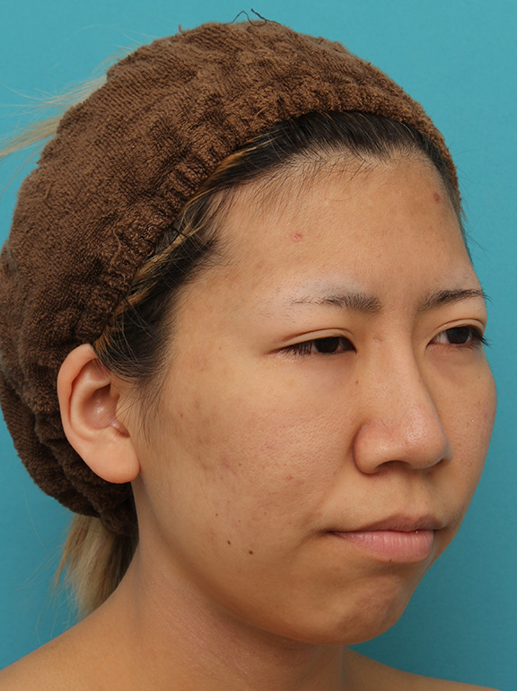 症例写真,20代女性の、総合的なお鼻のお悩みを手術で改善した症例写真,After（6ヶ月後メイクなし）,ba_ryubi1052_b03.jpg