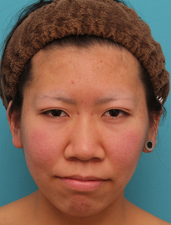 隆鼻術（シリコンプロテーゼ）,鼻翼縮小（小鼻縮小）,耳介軟骨移植（鼻先を出す）,鼻尖形成（鼻尖縮小・だんご鼻修正）,20代女性の、総合的なお鼻のお悩みを手術で改善した症例写真,Before,ba_ryubi1052_b01.jpg