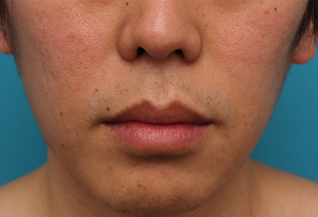 症例写真,上下の唇を薄くする手術の症例写真,手術前,口を閉じた状態,mainpic_usuku011a.jpg