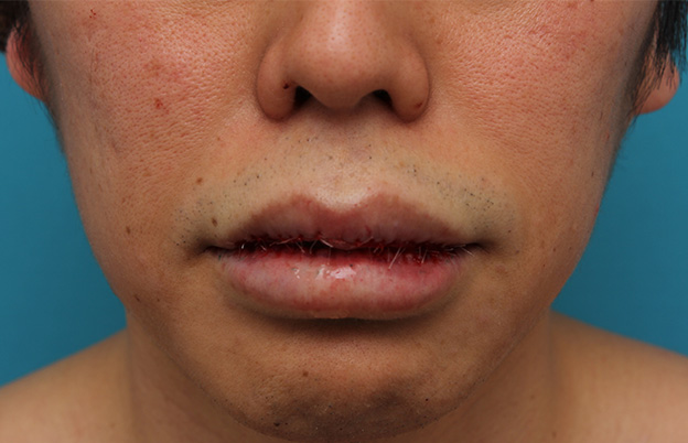 症例写真,上下の唇を薄くする手術の症例写真,手術直後,口を閉じた状態,mainpic_usuku011c.jpg