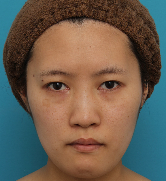 ミニフェイスリフトの症例 20代女性の頬を中心としたお顔のたるみの改善,Before,ba_minilift007_b01.jpg