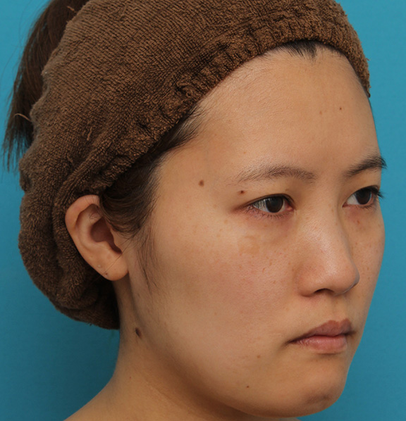 症例写真,ミニフェイスリフトの症例 20代女性の頬を中心としたお顔のたるみの改善,Before,ba_minilift007_b02.jpg