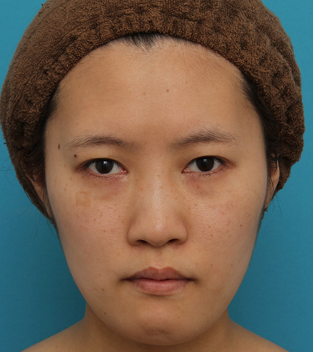 症例写真,ミニフェイスリフトの症例 20代女性の頬を中心としたお顔のたるみの改善,手術前,mainpic_minilift007a.jpg