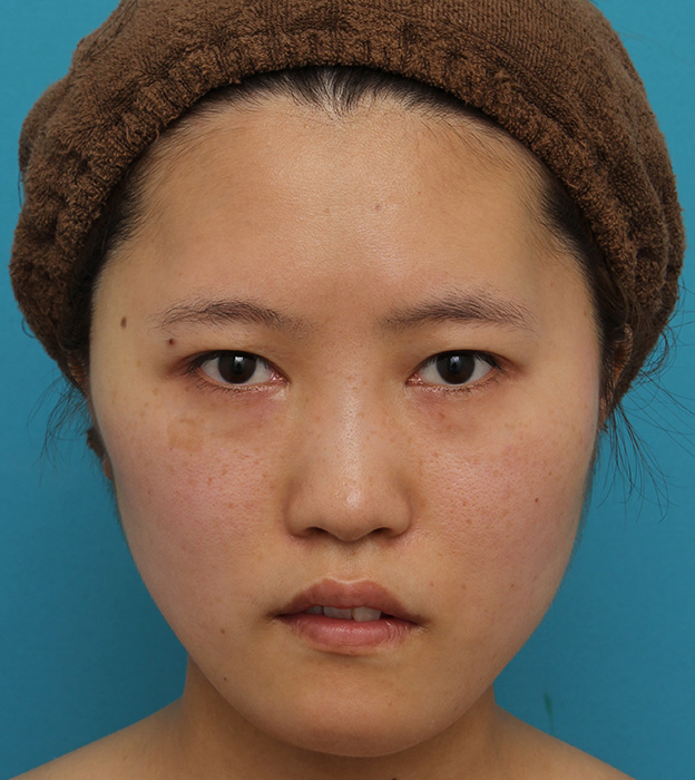 症例写真,ミニフェイスリフトの症例 20代女性の頬を中心としたお顔のたるみの改善,手術直後,mainpic_minilift007b.jpg