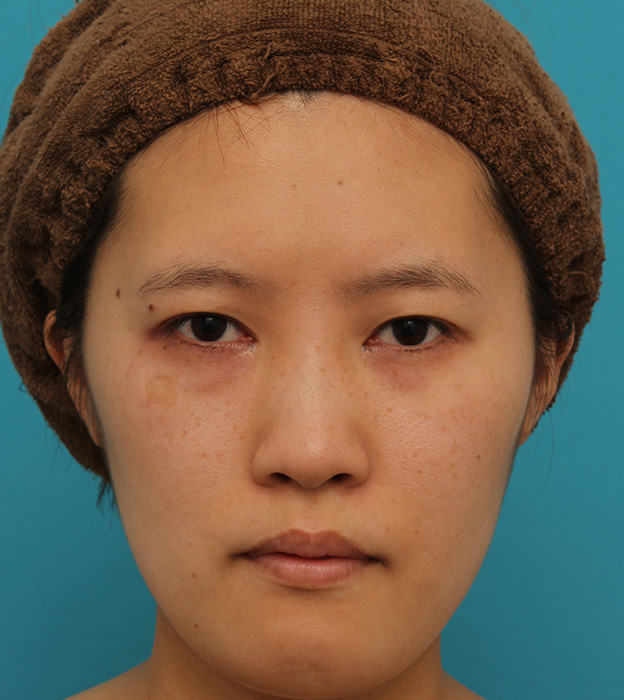 症例写真,ミニフェイスリフトの症例 20代女性の頬を中心としたお顔のたるみの改善,1ヶ月後,mainpic_minilift007d.jpg